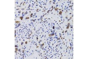 Immunohistochemistry of paraffin-embedded human gastric cancer using HDGF Antibody. (HDGF 抗体  (AA 1-240))