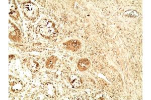 Immunohistochemistry analysis of human colon tumor tissue using Glucagon like peptide 1 pAb,  at a dilution of 1:500. (GLP-1 抗体  (AA 1-19))
