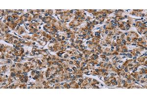 Immunohistochemistry of paraffin-embedded Human prostate cancer tissue using GTPBP10 Polyclonal Antibody at dilution 1:60 (GTPBP10 抗体)