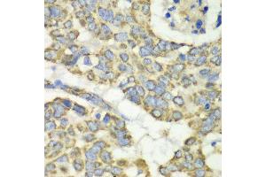 Immunohistochemistry of paraffin-embedded human esophageal cancer using TUFM antibody at dilution of 1:100 (x40 lens). (TUFM 抗体)