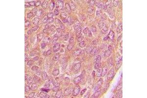 Immunohistochemical analysis of AKAP1 staining in human breast cancer formalin fixed paraffin embedded tissue section. (AKAP1 抗体)