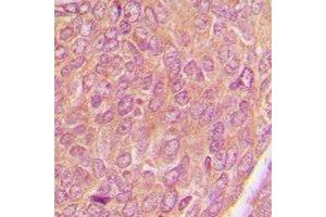 Immunohistochemical analysis of AKAP1 staining in human breast cancer formalin fixed paraffin embedded tissue section.