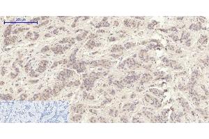 Immunohistochemistry of paraffin-embedded Human liver cancer tissue using MMP2 Polyclonal Antibody at dilution of 1:200. (MMP2 抗体)