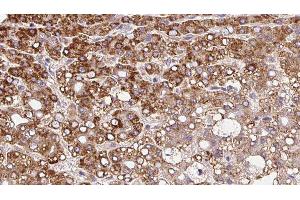 ABIN6279843 at 1/100 staining Human liver cancer tissue by IHC-P. (SLC8A1 抗体  (Internal Region))