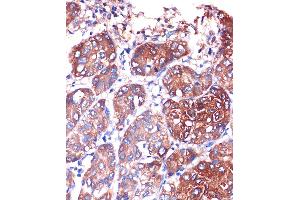 Immunohistochemistry of paraffin-embedded Human liver cancer using LYPL Rabbit pAb (ABIN1680728, ABIN3018907, ABIN3018908 and ABIN6220622) at dilution of 1:100 (40x lens). (LYPLA1 抗体  (AA 1-230))