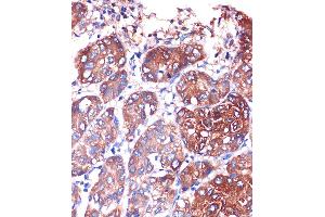 Immunohistochemistry of paraffin-embedded Human liver cancer using LYPL Rabbit pAb (ABIN1680728, ABIN3018907, ABIN3018908 and ABIN6220622) at dilution of 1:100 (40x lens). (LYPLA1 抗体  (AA 1-230))