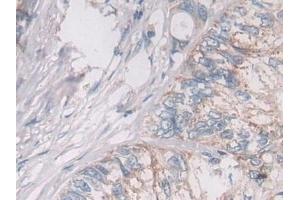 Detection of OAT in Human Colorectal cancer Tissue using Polyclonal Antibody to Ornithine Aminotransferase (OAT) (OAT 抗体  (AA 1-301))