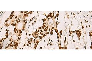 Immunohistochemistry of paraffin-embedded Human colorectal cancer tissue using ELF5 Polyclonal Antibody at dilution of 1:70(x200) (ELF5 抗体)