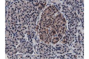 Immunohistochemical staining of paraffin-embedded Carcinoma of Human lung tissue using anti-BTN1A1 mouse monoclonal antibody. (BTN1A1 抗体)