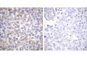 Peptide - +Immunohistochemical analysis of paraffin-embedded human breast carcinoma tissue using 14-3-3 ζ (Ab-58) antibody (#B0001). (14-3-3 zeta 抗体  (Ser58))