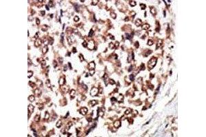 IHC analysis of FFPE human hepatocarcinoma tissue stained with the PKC nu antibody (PRKD3 抗体  (AA 860-890))