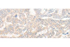 Immunohistochemistry of paraffin-embedded Human liver cancer tissue using CYB5R3 Polyclonal Antibody at dilution of 1:50(x200)