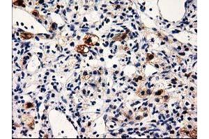 Immunohistochemical staining of paraffin-embedded Carcinoma of Human kidney tissue using anti-PRPSAP2 mouse monoclonal antibody. (PRPSAP2 抗体)