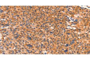 Immunohistochemistry of paraffin-embedded Human liver cancer using AMPD1 Polyclonal Antibody at dilution of 1:80 (AMPD1 抗体)