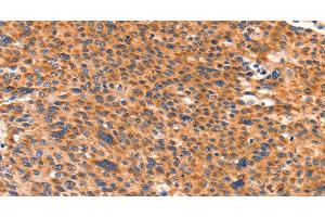 Immunohistochemistry of paraffin-embedded Human liver cancer using AMPD1 Polyclonal Antibody at dilution of 1:80