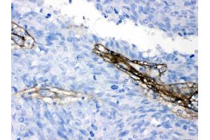 Collagen I was detected in paraffin-embedded sections of human lung cancer tissues using rabbit anti- Collagen I Antigen Affinity purified polyclonal antibody (Catalog # ) at 1 µg/mL. (COL1A1 抗体  (C-Term))