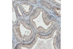 Immunohistochemical staining (Formalin-fixed paraffin-embedded sections) of human prostate cancer with OCLN monoclonal antibody, clone CL1555  shows membranous positivity in tumor cells. (Occludin 抗体  (AA 282-415))