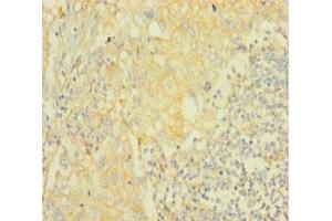 Immunohistochemistry of paraffin-embedded human lung cancer using ABIN7167028 at dilution of 1:100 (AKT2 抗体  (AA 2-481))