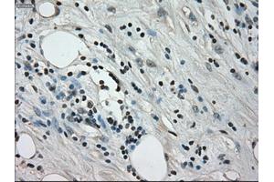Immunohistochemical staining of paraffin-embedded Adenocarcinoma of colon tissue using anti-CRYABmouse monoclonal antibody. (CRYAB 抗体)
