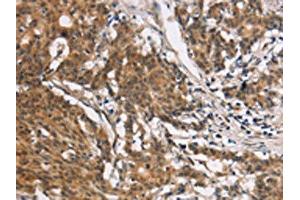 The image on the left is immunohistochemistry of paraffin-embedded Human gastic cancer tissue using ABIN7190329(COL7A1 Antibody) at dilution 1/25, on the right is treated with synthetic peptide. (COL7A1 抗体)