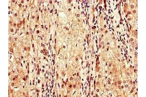 Immunohistochemistry of paraffin-embedded human liver cancer using ABIN7147989 at dilution of 1:100 (Coagulation Factor IX 抗体  (AA 144-239))