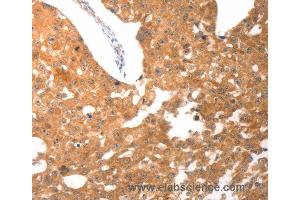 Immunohistochemistry of Human breast cancer using PARP1 Polyclonal Antibody at dilution of 1:25 (PARP1 抗体)