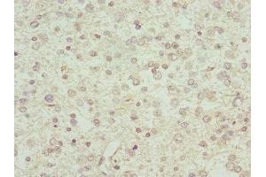 Immunohistochemistry of paraffin-embedded human glioma using ABIN7156561 at dilution of 1:100 (IFNA2 抗体  (AA 24-188))
