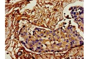 Immunohistochemistry of paraffin-embedded human breast cancer using ABIN7156781 at dilution of 1:100 (IL12A 抗体  (AA 23-219))