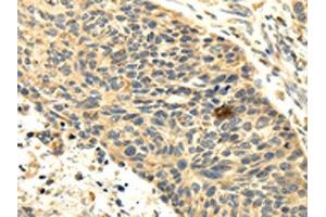 The image on the left is immunohistochemistry of paraffin-embedded Human esophagus cancer tissue using ABIN7131002(SEMA4F Antibody) at dilution 1/35, on the right is treated with fusion protein. (SEMA4F 抗体)
