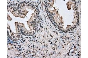 Immunohistochemical staining of paraffin-embedded Adenocarcinoma of colon tissue using anti-BSG mouse monoclonal antibody. (CD147 抗体)