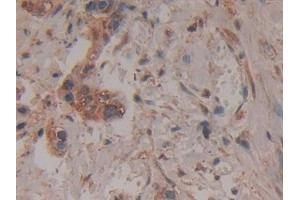 Detection of LILRB2 in Human Pancreatic cancer Tissue using Polyclonal Antibody to Leukocyte Immunoglobulin Like Receptor Subfamily B, Member 2 (LILRB2)