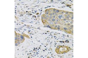 Immunohistochemistry of paraffin-embedded human lung cancer using KRT20 Antibody.