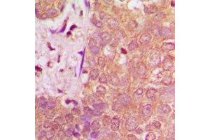 Immunohistochemical analysis of NAV1 staining in human breast cancer formalin fixed paraffin embedded tissue section. (NAV1 抗体)