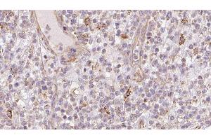 ABIN6273211 at 1/100 staining Human lymph cancer tissue by IHC-P. (CNPY2/MSAP 抗体  (C-Term))