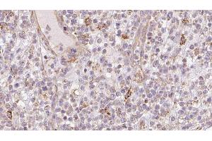 ABIN6273211 at 1/100 staining Human lymph cancer tissue by IHC-P. (CNPY2/MSAP 抗体  (C-Term))