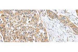 Immunohistochemistry of paraffin-embedded Human esophagus cancer tissue using CEMIP Polyclonal Antibody at dilution of 1:120(x200) (CEMIP 抗体)
