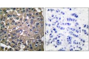 Immunohistochemistry analysis of paraffin-embedded human breast carcinoma tissue, using MMP-9 Antibody. (MMP 9 抗体  (AA 651-700))