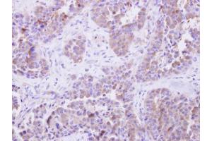 IHC-P Image SGTA antibody detects SGTA protein at cytosol on human lung adenocarcinoma by immunohistochemical analysis. (SGTA 抗体  (Center))