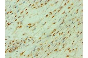 Immunohistochemistry of paraffin-embedded human breast cancer using ABIN7147792 at dilution of 1:100 (CLOCK 抗体  (AA 577-846))