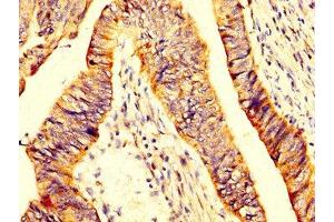 IHC image of ABIN7160496 diluted at 1:200 and staining in paraffin-embedded human colon cancer performed on a Leica BondTM system. (MYOC 抗体  (AA 183-294))