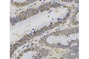Immunohistochemistry of paraffin-embedded Human rectal cancer using TriMethyl-Histone H3-K4 Polyclonal Antibody at dilution of 1:200 (40x lens).