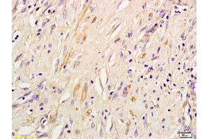 Formalin-fixed and paraffin embedded human lung inflammation labeled with Rabbit Anti IRS-3 Polyclonal Antibody, Unconjugated (ABIN726005) at 1:200 followed by conjugation to the secondary antibody and DAB staining (IRS3 抗体  (AA 261-360))