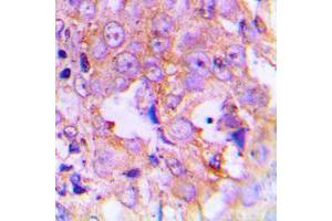 Immunohistochemical analysis of EEF2 (pT56) staining in human lung cancer formalin fixed paraffin embedded tissue section. (EEF2 抗体  (N-Term, pSer56))