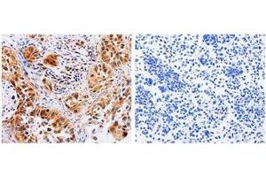 The image on the left is immunohistochemistry of paraffin-embedded Human lung cancer tissue using 31024 (AAK1 Antibody) at dilution 1/30, on the right is treated with the fusion protein. (AAK1 抗体  (N-Term))