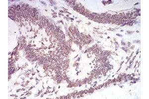 Immunohistochemical analysis of paraffin-embedded colon cancer tissues using LMNB2 mouse mAb with DAB staining.