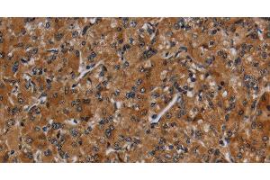 Immunohistochemistry of paraffin-embedded Human prostate cancer using CYP1A2 Polyclonal Antibody at dilution of 1:40 (CYP1A2 抗体)