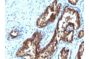 IHC testing of FFPE human prostate carcinoma with TDP2 antibody (clone TDP2/1258). (TDP2 抗体)