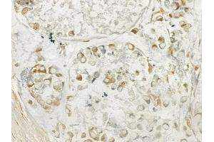ABIN6262558 and ABIN6277619 at 1/100 staining human gastric carcinoma by IHC-P. (IL-27 抗体  (Internal Region))