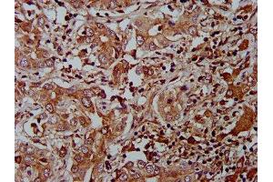 IHC image of ABIN7165027 diluted at 1:400 and staining in paraffin-embedded human liver cancer performed on a Leica BondTM system. (AHNAK2 抗体  (AA 195-349))
