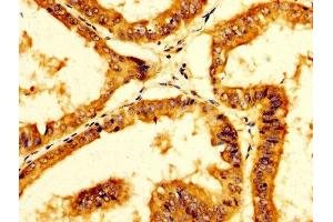 IHC image of ABIN7156276 diluted at 1:200 and staining in paraffin-embedded human endometrial cancer performed on a Leica BondTM system. (Pyrophosphatase (Inorganic) 1 (PPA1) (AA 59-173) 抗体)